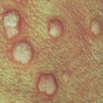 Trasmissione papilloma virus bagno - Tencuiala cu trei picioare