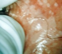 papilloma virus trasmissione bagni pubblici mod de infectare cu condilom